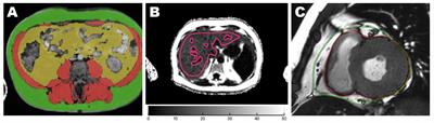 Differential association of abdominal, liver, and epicardial adiposity with anthropometry, diabetes, and cardiac remodeling in Asians